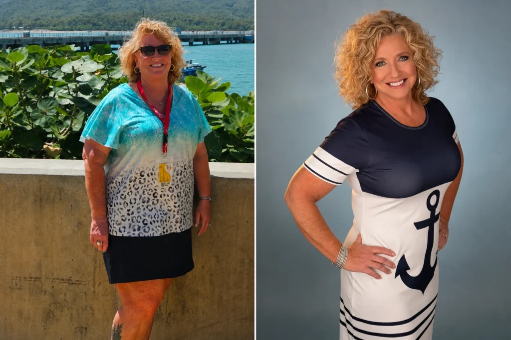 Amy before and after band to gastric bypass conversion at JourneyLite