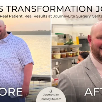 Side-by-side before and after weight loss transformation photos of Bobby at JourneyLite Surgery Center.