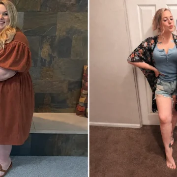 Callie before and after gastric sleeve surgery at JourneyLite