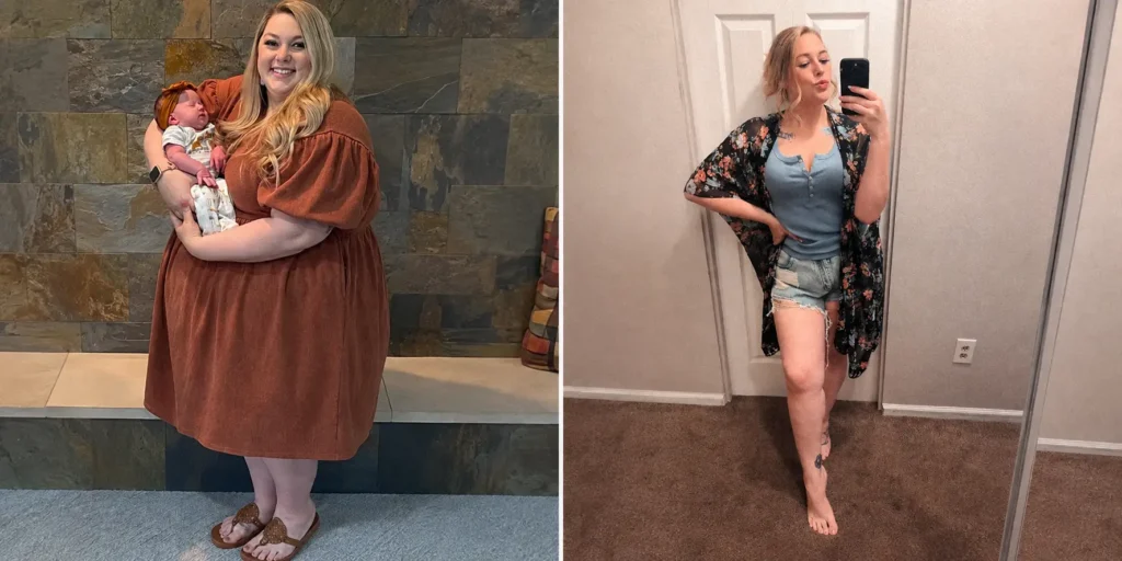 Callie before and after gastric sleeve surgery at JourneyLite