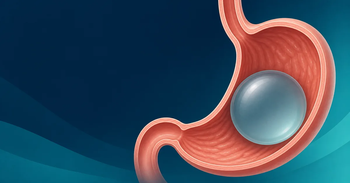 Simplified illustration of a single intragastric balloon positioned inside the stomach