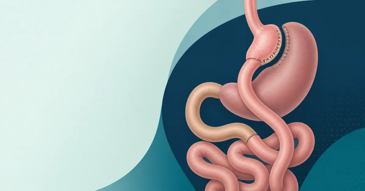 Simplified illustration of a gastric bypass stomach pouch and rerouted intestinal pathway